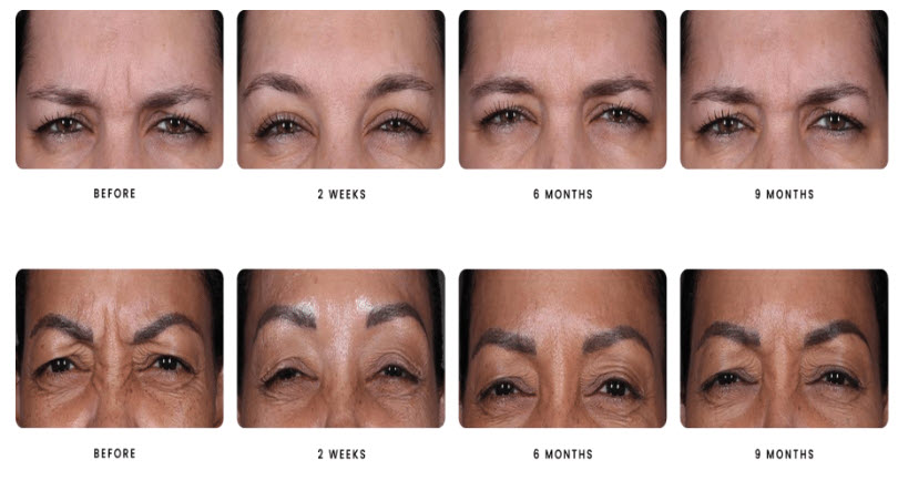 botox, Botox and Dysport – Wrinkle Relaxers